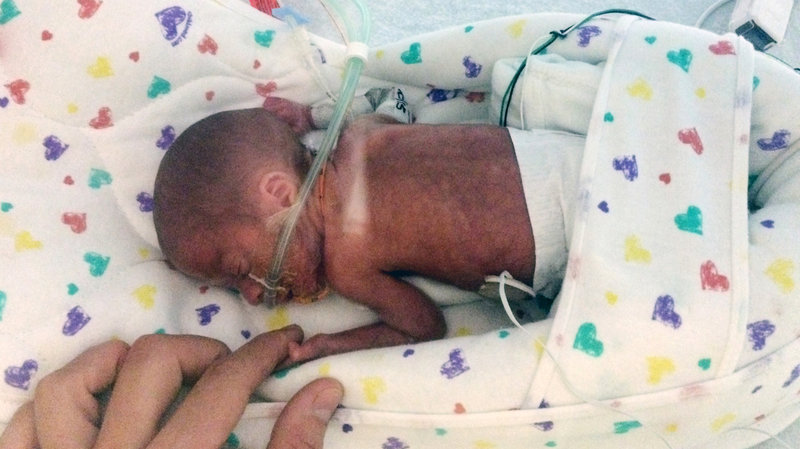 baby born three months early